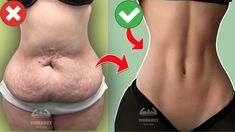 before and after pictures of tummy surgery with the results shown in red, white and green