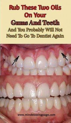 10 easy ways to treat receding gums naturally! #FitLife #FitnessTips #HealthyLiving #SelfCare #NutritionTips #HealthTips #HealthyLifestyle #Wellness Teeth Hacks, Natural Teeth Whitening Diy, Dental Tips, Teeth Whitening Remedies, Teeth Whitening Diy, Dental Cavities