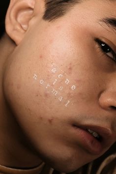 Different Types Of Acne, Types Of Acne, Real Bodies, Glow Skin, Foto Art, Beauty Standards, Body Love, Body Image, Skin Conditions