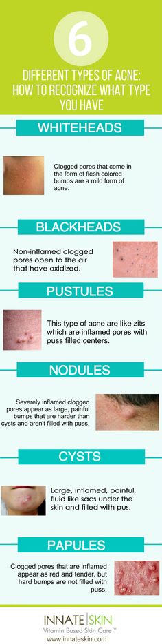 Different types of acne can sometimes require different treatments. Knowing the different types of acne you may have can be a key piece of the puzzle towards clear skin. In general, acne and all of its variations are caused by oxidized sebum and clogged pores. Here is a list of the main types of acne and a […] Acne Types, Different Types Of Acne, Natural Acne, Types Of Acne, How To Get Rid Of Pimples, Acne Breakout, How To Get Rid Of Acne, Clogged Pores, Acne Skin