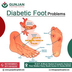 Don’t take diabetic foot lightly. Diabetic foot ulcers are open wounds or sores that can lead to infection if not treated early. Aside from ulcers, patients may suffer from other conditions affecting their feet. Visit Gunjan Hospital for more information. #gunjanhospitalcare #healthcare #diabetes #diabeticfootcare #diabetesawareness #diabeticfootulcer #Ulcers Medical Jewelry, Blood Flow, Health Care, More Information, Health, Books