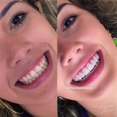 Perfect Smile Teeth Women, Perfect Teeth Smile, Perfect Smile Teeth, Dental Makeover, Cosmetic Dentistry Veneers, Fuller Lips Naturally, Cosmetic Dentistry Procedures, Skin Tightening Treatments, Pretty Teeth