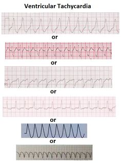 Nursing Iv, Er Nursing, Medical School Interview, Er Tech, Physician Assistant School, Ekg Interpretation, Paramedic School