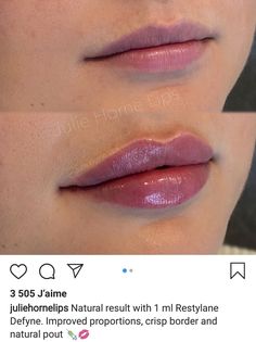 Lip Fillers Juvederm, Dermal Fillers Lips, Juvederm Lips, Lips Inspiration, Botox Lips, Facial Fillers, Lip Augmentation, Injectables Fillers, Facial Aesthetics