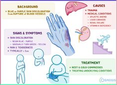 Ecchymosis, commonly known as a bruise, refers to the discoloration of the skin due to the rupture of the blood vessels below the surface of the skin Medical Study, Subcutaneous Tissue, Study Essentials, Lower Back Pain Exercises, Below The Surface, Toning Workouts, Skin Discoloration, Health Facts