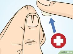 How To Repair A Split Fingernail, How To Repair Split Nails, Repair Split Nail, How To Stop Nails From Splitting, Split Fingernails Remedies, Repair Nails After Acrylics, Heal Nails After Acrylics, Healing Nails After Gel, Ripped Nail Bed Repair