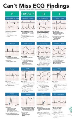 A high yield, on-shift resource to help Emergency Department providers spot subtle, high-risk ECG findings including Brugada, WPW, HCM, and ARVD. Use this card as a checklist to methodically ensure you are not missing any electrocardiographic evidence of red-flag conditions. Medische Humor, Cardiology Nursing