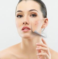 Pimples can make you feel less confident and take a toll on you mentally. But why worry when you can get rid of pimples with simple remedies. Check them out now! Scar Removal Cream, Facial Tips, Scar Cream, How To Get Rid Of Pimples, Acne Facial, Scar Removal, Image Skincare, Top Nail, Nail Fungus