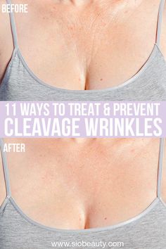 Chest Wrinkles Remedies Diy, How To Get Rid Of Chest Wrinkles, Neck And Chest Skin Care, Crepey Neck Skin Remedies Diy, Chest Wrinkles Remedies, Neck And Decollete Care, Neck Creases How To Get Rid Of, Sun Damaged Skin Remedies, How To Tighten Neck Skin