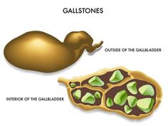 Gallbladder Stones Diet, Gallbladder Flush, Quadrants Of The Abdomen, Gallbladder Cleanse, Gallbladder Stones, Herbal Vitamins, Gallbladder Health, Mthfr Gene Mutation, Gallbladder Diet