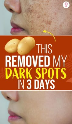 Black Skin Care Dark Spots, Skin Spot Remover, Wrinkles Remedies Face, Diy Masks, Brown Spots On Skin, Dark Spots On Face, Natural Face Skin Care, Black Skin Care, Tips Skincare