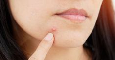 Learn tips for managing big pimples effectively. From skincare products to natural remedies, learn how to relieve, prevent, and achieve clearer, healthier skin. Painful Pimple, Pimple Causes, Different Types Of Acne, Blind Pimple, Forehead Acne, Pimples Under The Skin, دورة شهرية, How To Reduce Pimples, Pimples Overnight