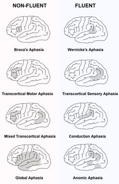 four different types of the brain are shown in black and white, one is labeled