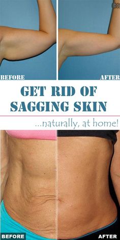 Remedies For Skin, For Skin Tightening, Home Remedies For Skin, Crepey Skin, Beauty Remedies, Skin Remedies, Trening Abs, Loose Skin