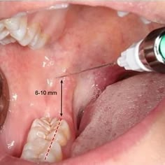 DENTISTRY MY WORLD® on Instagram: “Inferior Alveolar nerve block technique. Tag your friends 👇 Follow @dentistrymyworld for more ❤” Dental Pictures, Dental Photos, Dental World, Dental Posters, Dental Videos