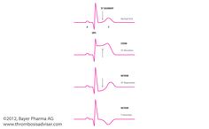 STEMI (ST-Elevation Myocardial Infarction) & NSTEMI (Non-ST-Elevation Myocardial Infarction) ECG St Elevation Ekg, Coagulation Cascade, St Elevation, Coronary Artery, Hello Nurse, Atrial Fibrillation