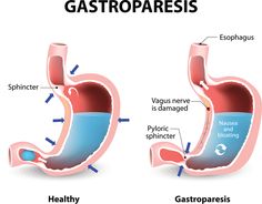 Gastroparesis delayed gastric emptying causes Nerf Vague, Top 10 Home Remedies, Vagus Nerve, Abdominal Pain, Acid Reflux, Best Diets, Home Remedies, Diet