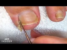 How to Clean Toe Nails: 11 Steps (with Pictures) - wikiHow Clean Feet Nails, Clean Toe Nails, Clean Toenails, Toenail Removal, Black Toe Nails, Foot Nail, Out Of Mind, Cuticle Remover, Thick Skin