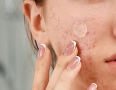 How to Deal with a Big Pimple on Your Face: Expert Tips for Quick Relief - Real Beauty School Healthier Skin, Beauty School, Health And Beauty Tips, Real Beauty, Skincare Products, Natural Remedies, Beauty Tips