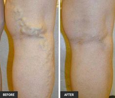 If you have vein problems, our gallery of varicose veins before and after pictures will help you see what sort of results you can expect with treatment from LLAV; see them here! Vein Disease, Home Remedies For Spiders, Leg Circulation, Varicose Vein Removal, Varicose Vein Remedy, Vein Removal, Edgar Cayce, Laser Lipo, Skin Clinic