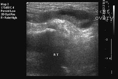 The above ultrasound images show a female neonate with right inguinal hernia containing the right ovary. The right ovary is seen as an oval structure with multiple small cystic areas (follicles) Ultrasound, Map