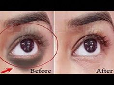 In this video, we will show you how to effectively remove dark circles, under eye wrinkles, and eye bags in just 7 days using a powerful anti-aging eye mask ... Dark Circle Remedies Overnight, Eye Circle Remedies, Dark Spots Under Eyes, Dark Circle Remedies, Dark Circles Around Eyes, Cucumber On Eyes, Eye Wrinkles, Wrinkle Remedies, Dark Eye Circles