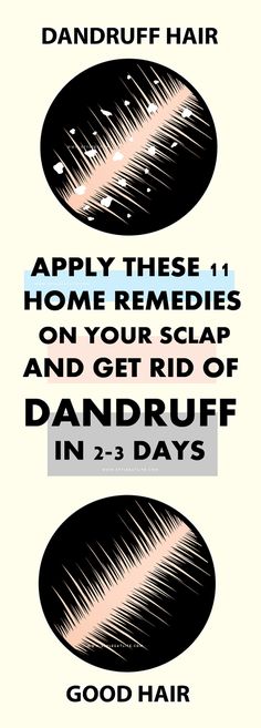 11 Effective Home Remedies to Get Rid of Dandruff Permanently! Remove Dandruff Home Remedies, Ginger Benefits, Hair Cleanser