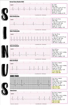 EKG strip reading broken down Ekg Interpretation Made Easy, Ekg Interpretation, Basic Anatomy And Physiology