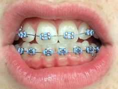 Light Blue Braces, Rainbow Braces, Braces Transformation, Pink Braces, Braces Food, Braces Bands