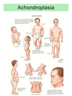 an image of the human body and its functions in achndroplasia