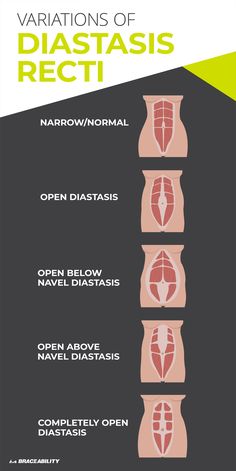 an info sheet describing the various variations of diastasis and how to use it