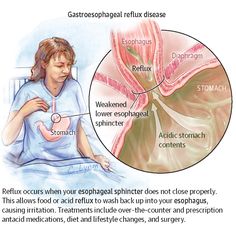 a diagram showing the effects of gastrophanal refluxs and stomach