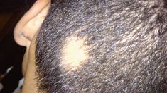 Scalp Conditions: Pictures, Causes, and Treatments Sores On Scalp, Baldness Solutions, Androgenetic Alopecia, Dramatic Hair, Hair Transplant Surgery, Male Pattern Baldness, Pattern Baldness, Regrow Hair