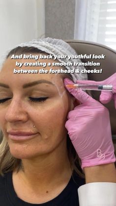 Temple Filler Before And After, Temple Filler, Facial Injections, Cosmetic Fillers, Botox Filler, Botox Face, Facial Fillers, Cosmetic Injectables, Beauty Boost