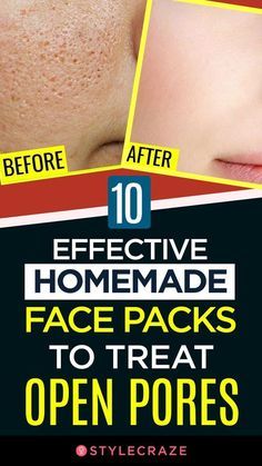 Skin Care Procedures, Homemade Face Pack, Acne Prone Skin Care, Lotion For Oily Skin, Tips For Oily Skin, Oily Skin Acne, Anti Wrinkle Skin Care, Open Pores