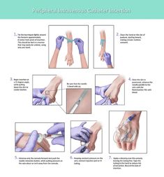 instructions on how to use the periphan intravenous catheter insertion