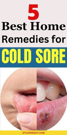 Dealing with the discomfort and inconvenience of a cold sore can be a common concern, and finding an effective remedy that works swiftly is often a top priority. Whether you're looking to alleviate the pain, reduce the duration of a cold sore outbreak, or prevent future occurrences, understanding the best remedies that work fast can make a significant difference. Check out the most effective cold sore remedies that can be easily implemented at home. #remedy #health #lifehacks #homeremedies Cold Sore Remedies, Natural Cold Sore Remedy, Home Remedies For Cold, Cold Sore Relief, Home Remedies For Allergies, Home Remedies For Warts, Get Rid Of Cold, Warts Remedy, Natural Remedies For Migraines