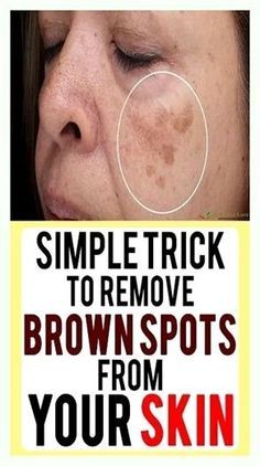 Age Spot Removal, Skin Spots, Spots On Face, Baking Soda Shampoo, Skin Remedies