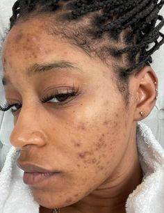 Forehead Acne, Pacific Islander, Acne Causes, Best Serum, Keke Palmer, Brighten Skin Tone