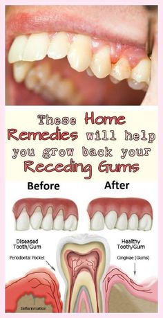 7 Natural Ways To Treat Receding Gums Heal Cavities, Swollen Gum, Poor Nutrition, Teeth Health, Receding Gums, Gum Care, Gum Health, Oral Health Care, Tooth Decay