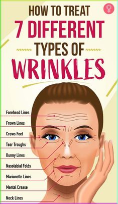 How To Treat 7 Different Types Of Wrinkles: Wrinkles Remedies Face, Wrinkle Remedies, Wrinkle Free Skin, Forehead Wrinkles, Skin Care Wrinkles, Baking Soda Shampoo, Eye Wrinkle, Deep Skin