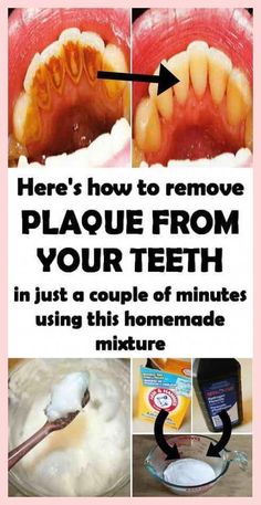 It reduces the presence of plaque, while reaching and fighting bacteria that escaped dental cleaning at the same time..
#dentalhealth, #dentalhealthcare How To Remove Plaque, Baby Tooth Decay, Tooth Decay Remedies, Plaque Removal, Dental Cleaning, Oral Care Routine, Gum Care, Receding Gums, Oral Health Care