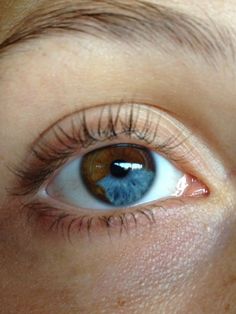 heterochromia: Sectoral Heterochromia, Pretty Eyes Color, Heterochromia Eyes, Head Anatomy, Eye Parts