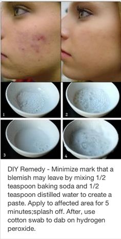 #DIY Remedy- Minimize a mark that a blemish may leave by mixing 1/2 tsp baking soda and 1/2 tsp distilled water to create a paste. Apply for 5 minutes, splash off. After use a cotton swab to dab hydrogen peroxide. #Beauty  #Acne Make Up Diy, How To Reduce Pimples, Baking Soda Shampoo, Clear Skin Tips, Pimple Marks, Diy Remedies, Makijaż Smokey Eye, Beauty Remedies, Acne Remedies