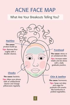 Acne face map Pimple Chart, Face Acne Remedies, Acne Chart, Acne Face Map, Face Map, Face Mapping Acne, Blind Pimple, Forehead Acne, Pimples Under The Skin