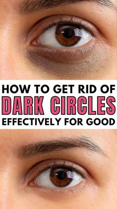 "Bye-Bye Dark Circles and Puffy Eyes: Effective Remedies and Treatments!"Dark circles and puffy eyes got you down? No worries! In this informative video, we'... Eye Cream For Dark Circles, Under Eyes