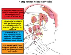 Punkty Spustowe, Relief Headache, Tension Headache Relief, Headache Relief Instant, Throbbing Headache, Headache Types, Essential Oils For Headaches, Trigger Point Therapy, Natural Headache Remedies