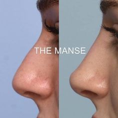 Luxury Clinic, Non Surgical Rhinoplasty, Nose Filler, Upturned Nose, Parts Of The Nose, Nose Reshaping