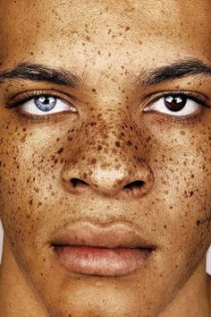 an image of a man with freckles on his face and the caption reads,