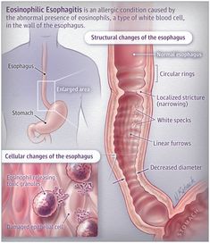 Eosinophilic Esophagitis Eosinophilic Esophagus Diet, Esophagus Problems, Eosinophilic Esophagus, Esophageal Spasm, Gastrointestinal System, Human Body Anatomy, Nursing Notes